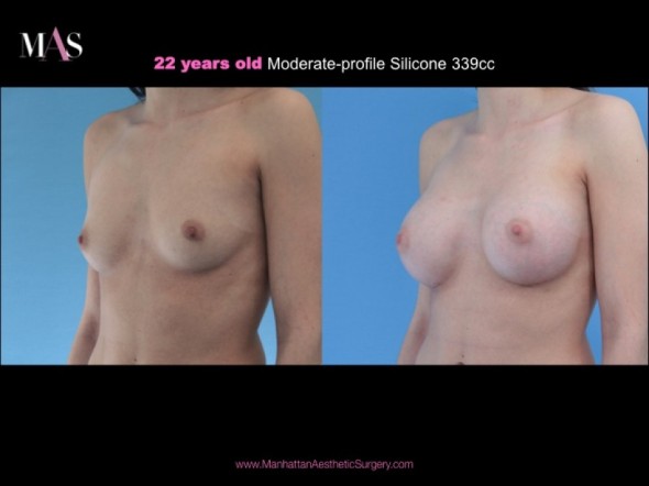 breast augmentation before and after c. Before and After Breast
